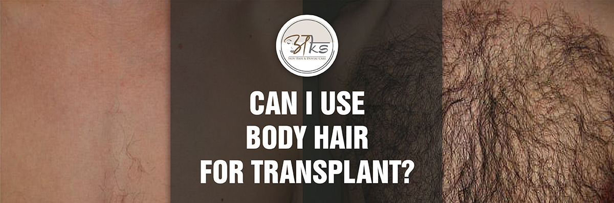 Can I Use Body Hair For Transplant 